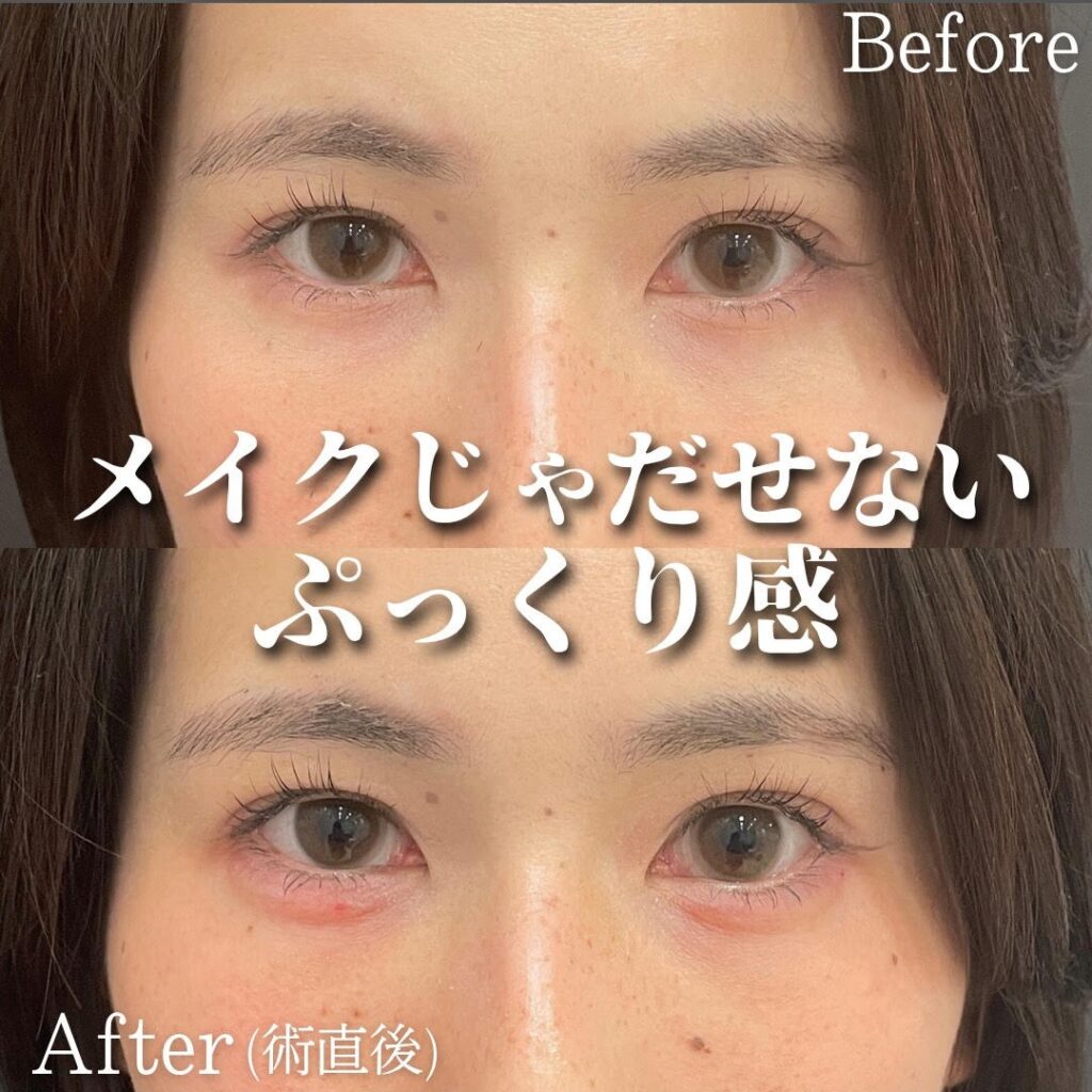 ヒアルロン酸（涙袋）の症例