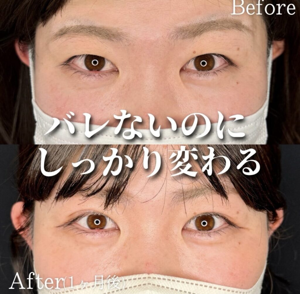 二重埋没法　自然癒着法の症例