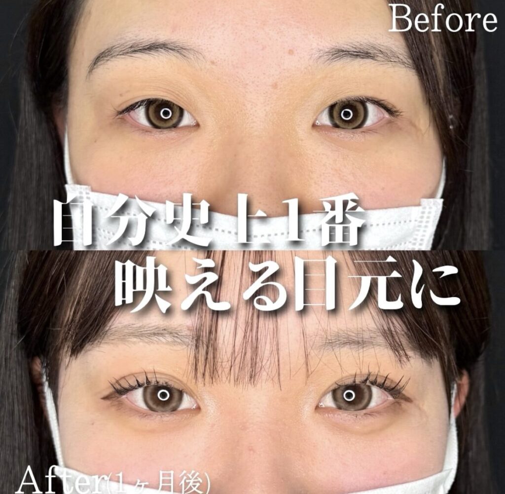 二重埋没法　自然癒着法の症例