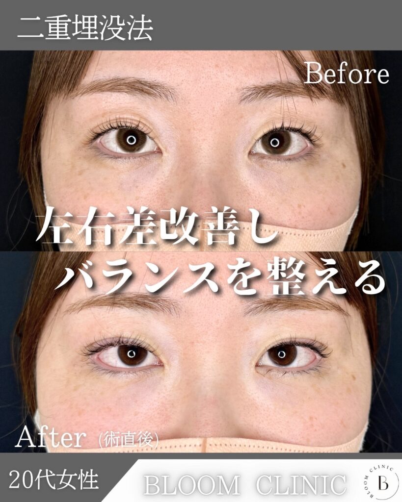 二重埋没法　自然癒着法の症例