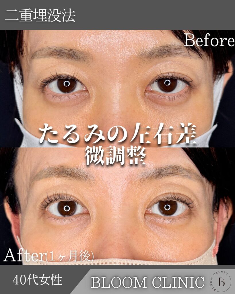 二重埋没法　自然癒着法の症例