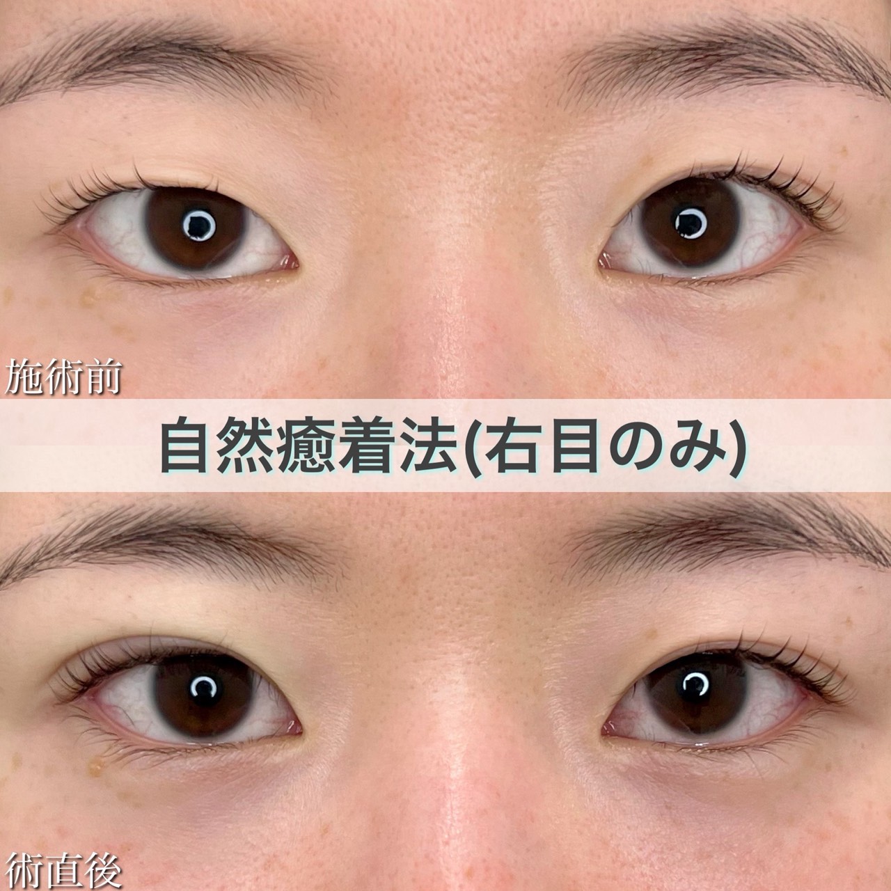 自然癒着法（右目のみ）の症例