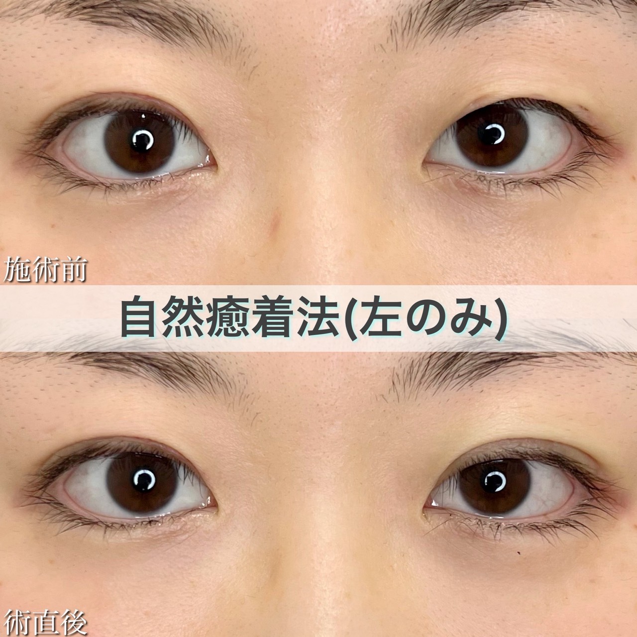 自然癒着法（左目のみ）の症例