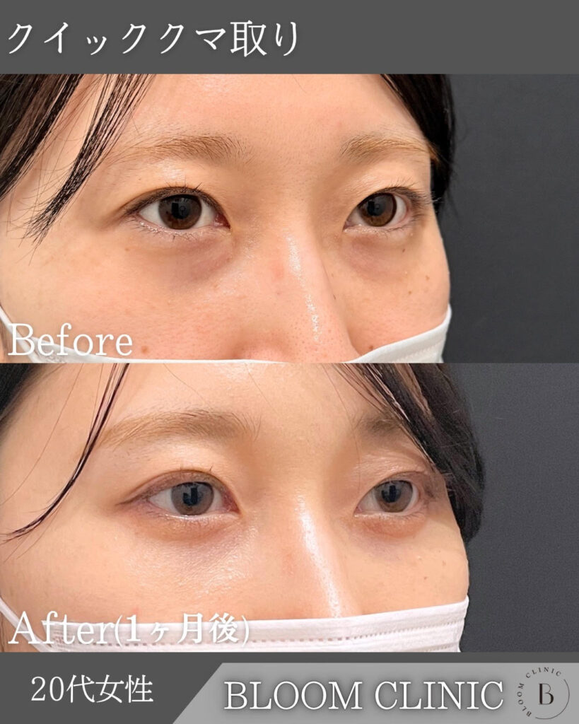 クマ取り（目の下の脂肪取り）の症例