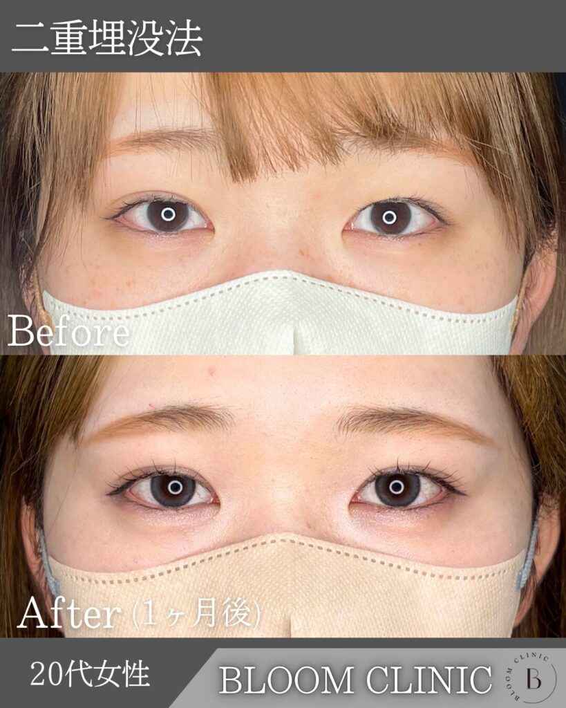 二重埋没法　自然癒着法の症例