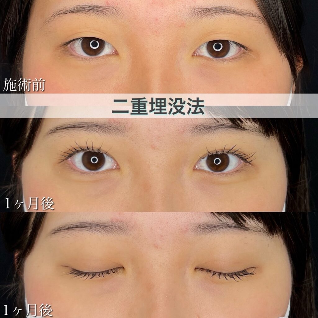 二重埋没法　自然癒着法の症例