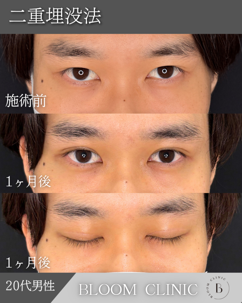 二重埋没法　自然癒着法の症例